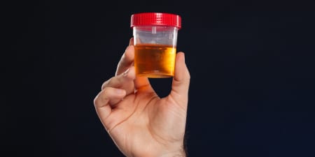 A urine sample with blood.