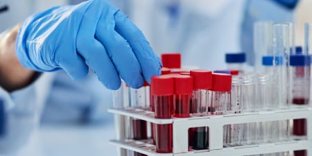 Blood samples for testicular cancer test.