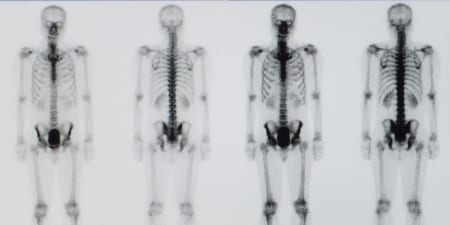 A film showing the result of bone scan.