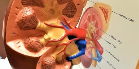 A model of kidney showing the calculi formation.