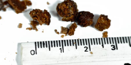 Cystine and Struvite stones removed from kidneys.