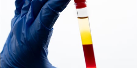 Urine sample with blood and blood clots to diagnose hematuria.
