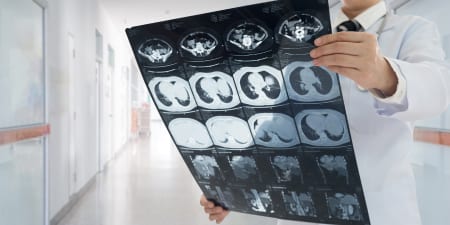 An urologist checking a bone X-ray for spread of cancer.