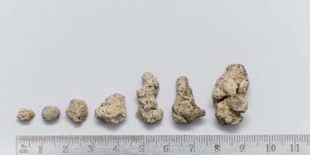 Renal stones larger than 2 centimeters.