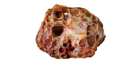 A poly-cyst removed from kidney.
