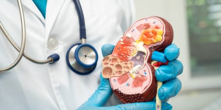 An urologist holding a kidney model showing showing small tumors.