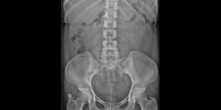 An X-ray film of retrograde pyelogram.