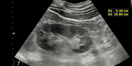 Ultrasound imaging, a procedure to identify ureteric stricture.