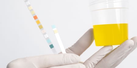 Urine sample ready for urine test to diagnose kidney stone.