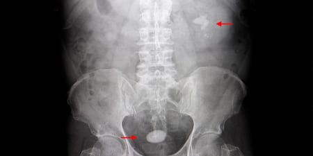 Cystogram X-ray report for urinary incontinence.