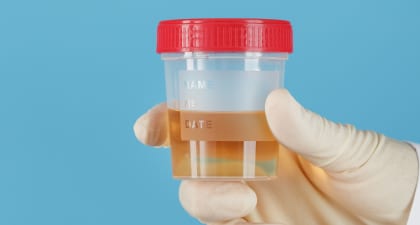 Urine sample collected for a complete urine analysis to diagnose lower urinary track issues.