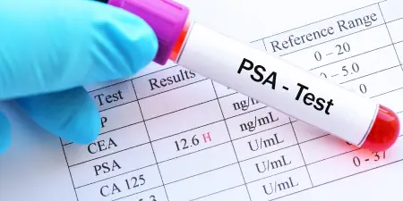 Blood sample for Prostate-specific antigen (PSA) test.