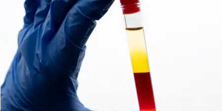 Urine sample with blood and blood clots to diagnose hematuria.