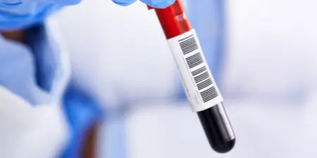 Blood samples ready to be tested for kidney cancer.