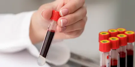 Blood samples ready for prostate specific antigen PSA test.