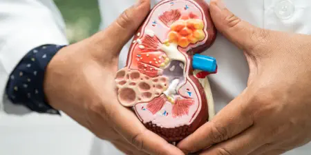 An urologist holds a kidney model showing the calculi formation.