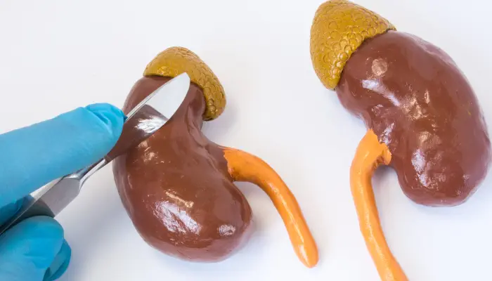 Close-up view of an urologist trying to operate a kidney model illustrate Robotic Partial Nephrectomy surgery.