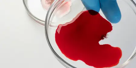 Blood sample ready for testing to diagnose bladder and urinary track issues.