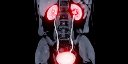 An X-ray film of intravenous urography(IVU).