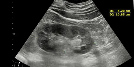 Ultrasound imaging, a procedure to identify ureteric stricture.
