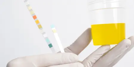 Urine sample ready for urine test to diagnose kidney stone.