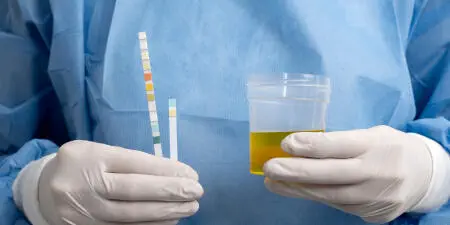 Urine sample ready for urine analysis for urinary incontinence.