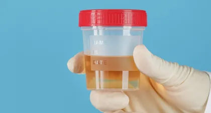 Urine sample collected for a complete urine analysis to diagnose lower urinary track issues.