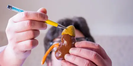 An urologist pointing a kidney model with adrenal gland for adrenal tumors.