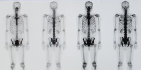 A film showing the result of bone scan.