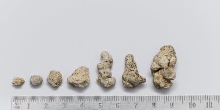 Renal stones larger than 2 centimeters.