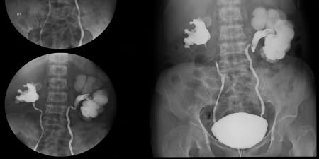 Diagnostic x-rays showing abnormalities in urinary track.