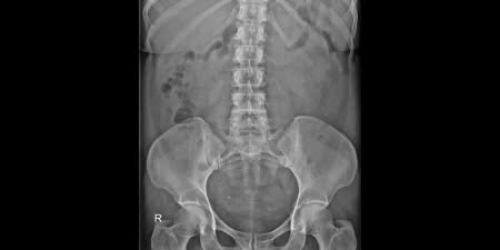 An X-ray film of retrograde pyelogram.